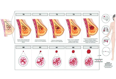 About Breast Cancer