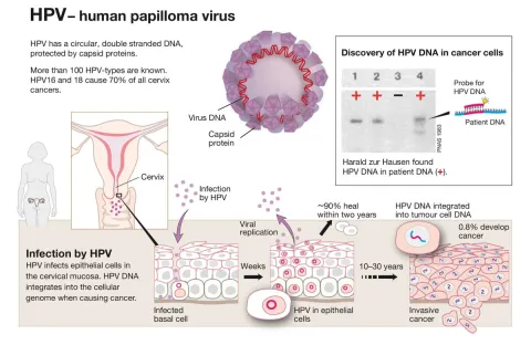 Virologist Harald zur Hausen discovered how cervical cancer is triggered by virus infections. His work led to the creation of the HPV vaccine which cuts the risk of developing cervical cancer.