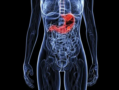WCRF CUP report on stomach cancer WCRF CUP report on stomach cancer