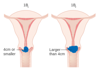 Diagram_showing_stage_1B_cervical_cancer_CRUK_203.svg_.png